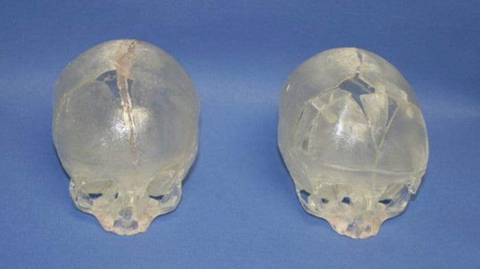 Surgeons Reconstruct Babys Skull With 3d Printing Technology Fox News