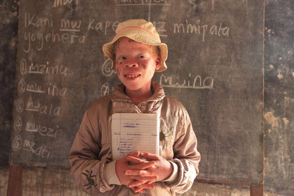 Malawi mengalami peningkatan serangan terhadap orang albino;  korban berbicara