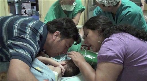 Chilean Conjoined Twins Separated