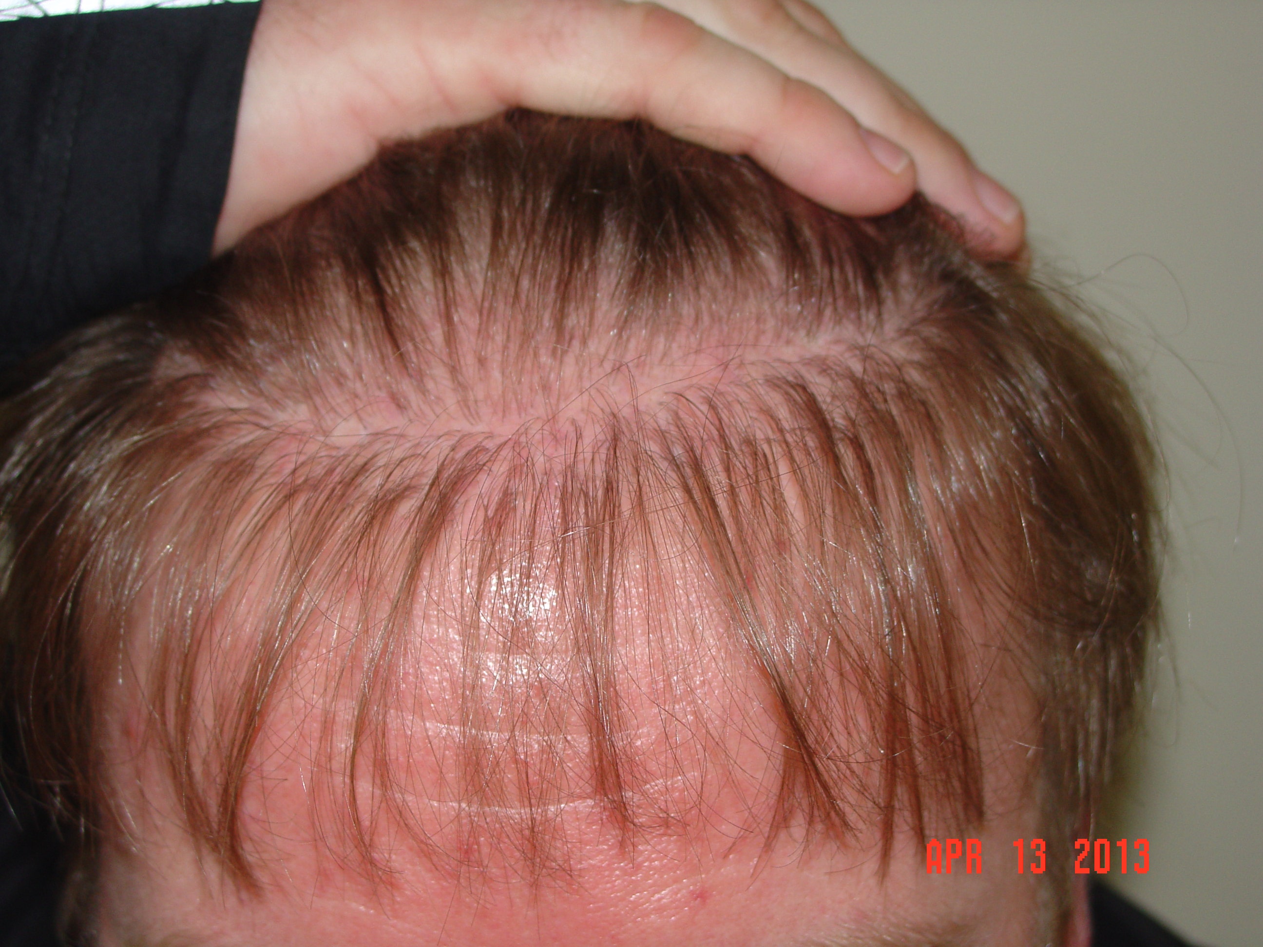 Hair Loss Solutions Dallas