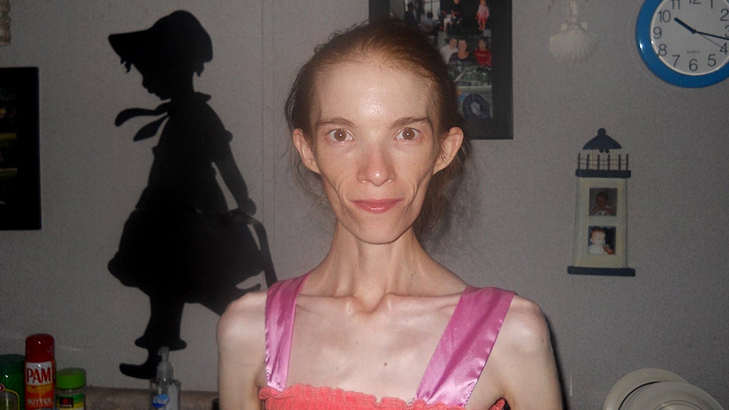 Anorexic woman is given choice to seek outofstate medical treatment