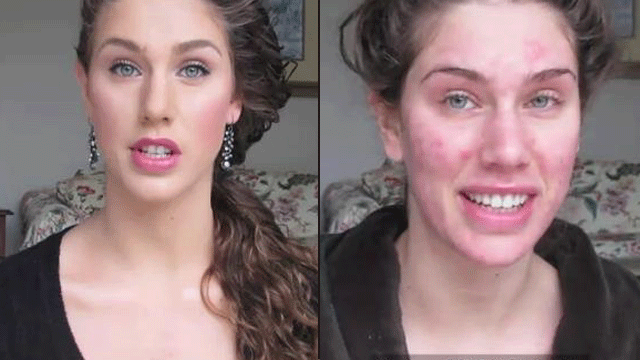 Cassandra Bankson before and after (left) applying makeup to cover her acne scars (YouTube).