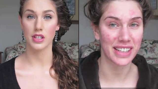 acne before and after makeup