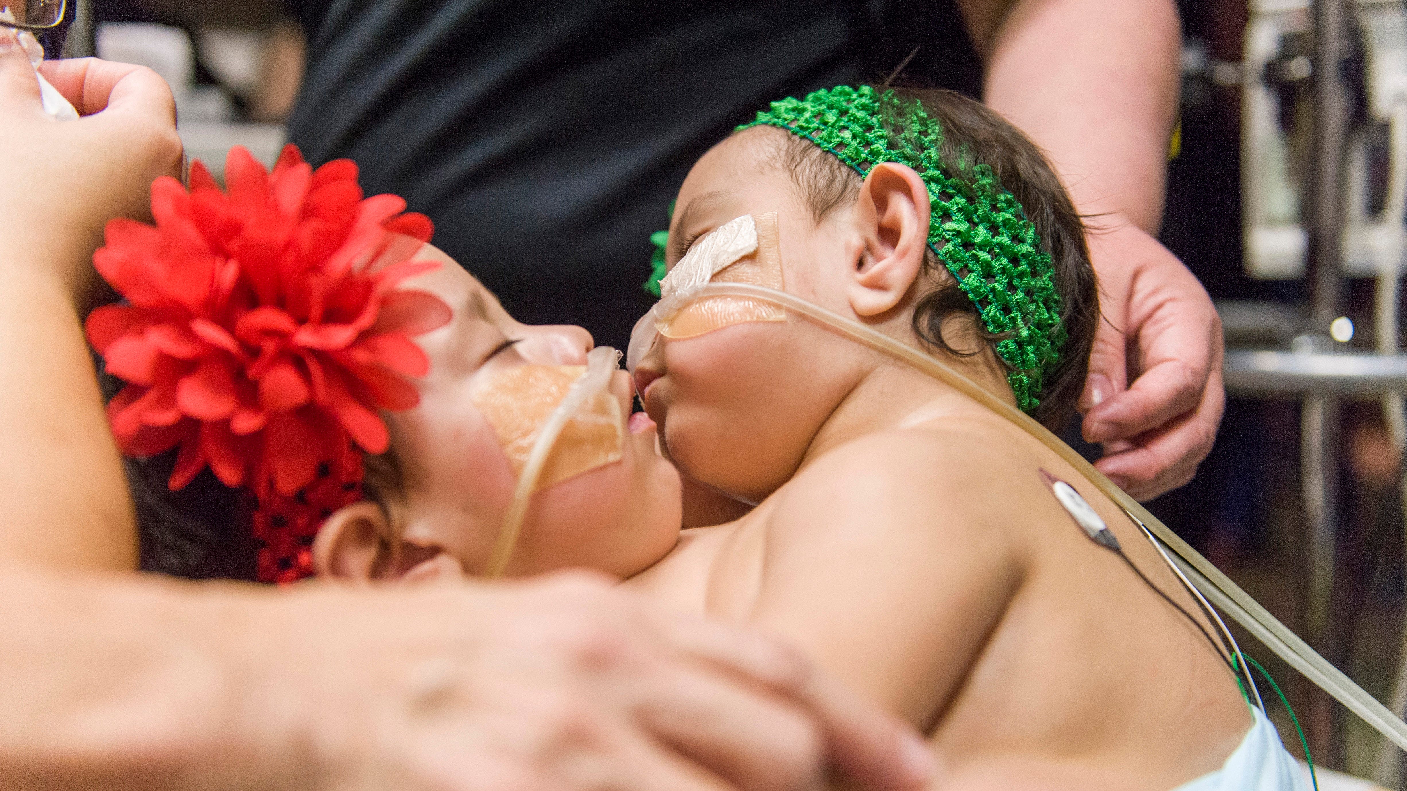 Beautiful 10-month-old conjoined twins will finally lead separate lives