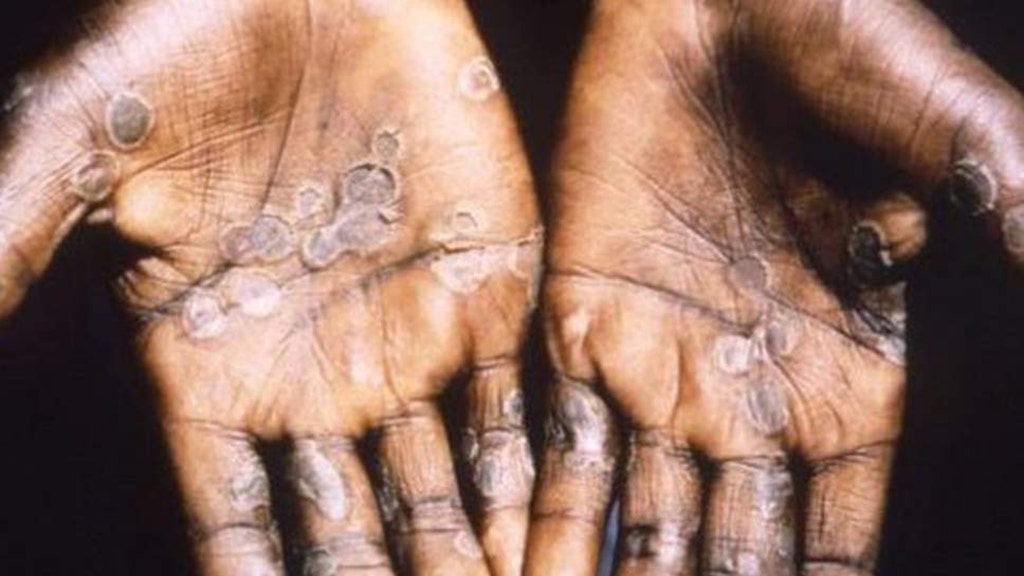 UK confirms more cases of monkeypox