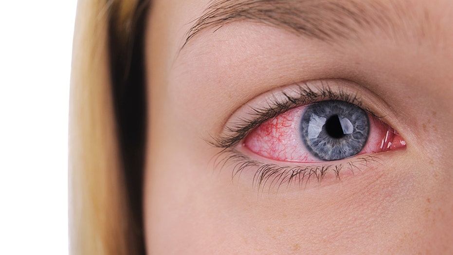 Brewers have pink eye, so no high-fives