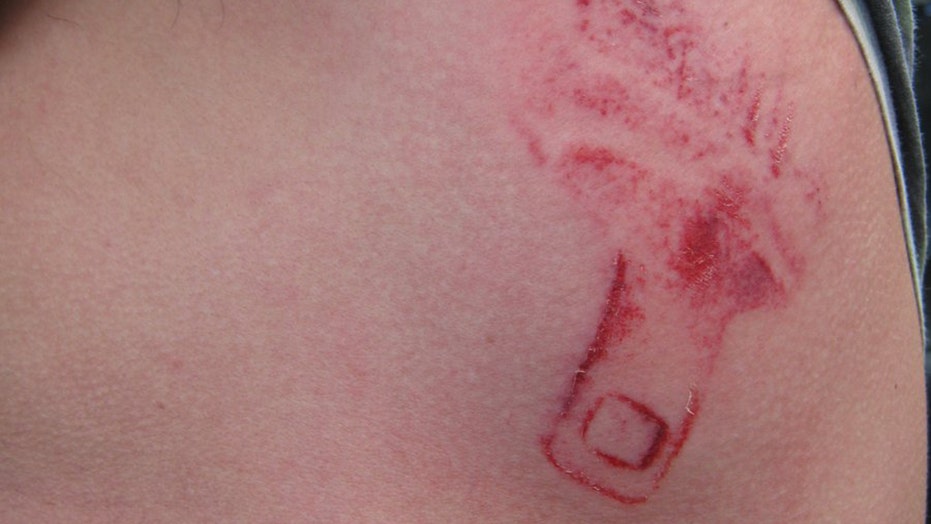 Seatbelt leaves its mark on man after crash 'Not A Tattoo,' authorities say Fox News