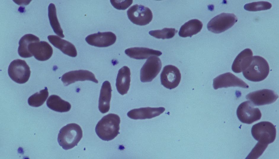 Bone marrow transplants can reverse adult sickle cell disease | Fox News