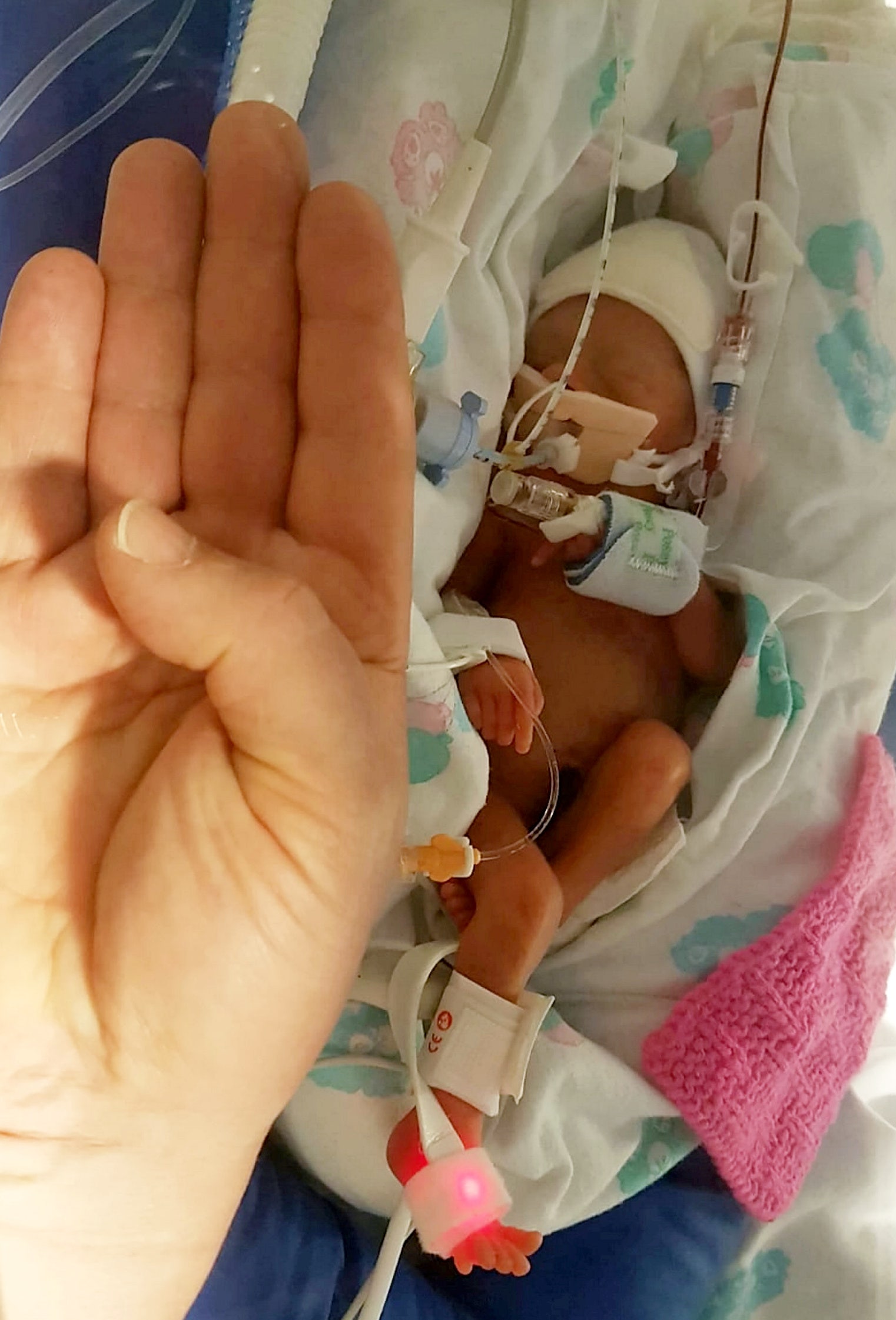 miracle-baby-who-weighed-under-2-pounds-thriving-6-months-later-fox