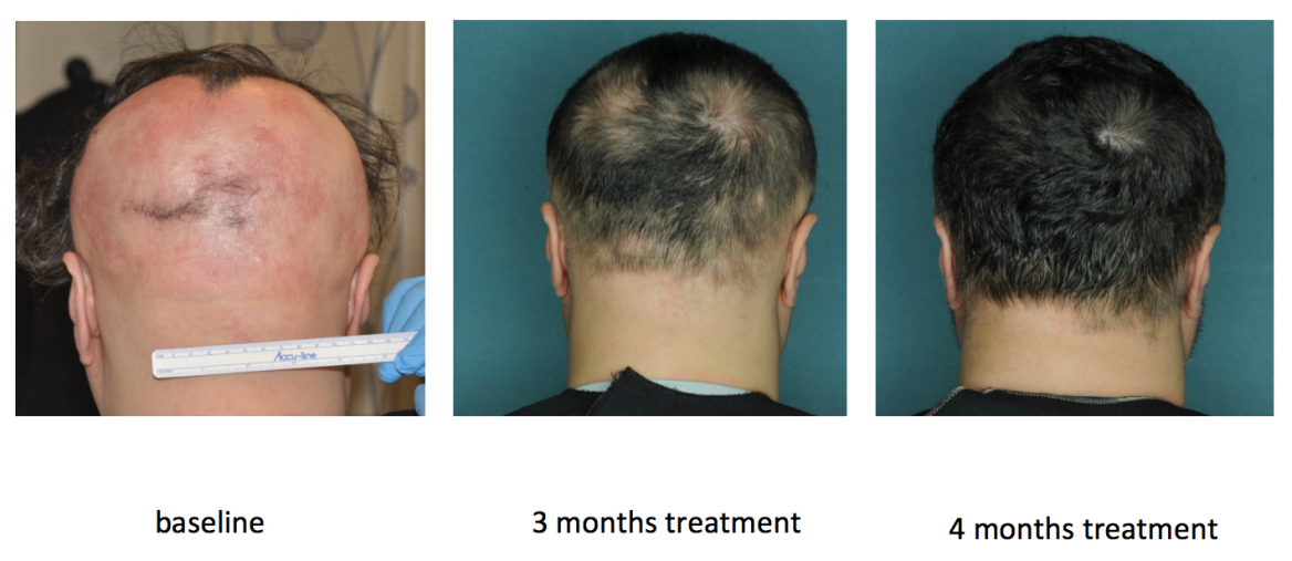Researchers find 'miracle cure' for baldness