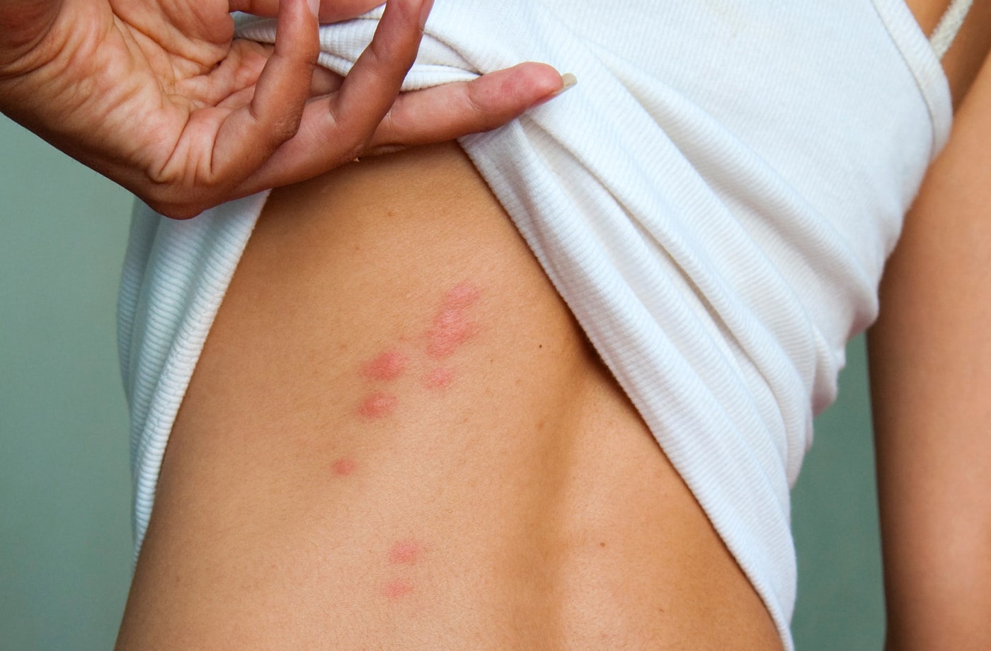 How Long For Insect Bites To Go Away