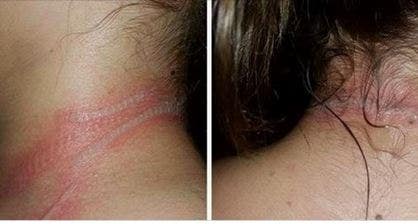 cigarette burn on neck Freak accident with cellphone leaves teen with second-degree burns on neck