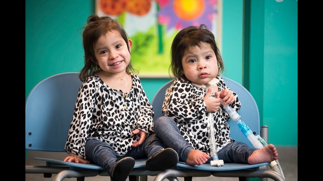 Conjoined Twins Born In Texas Thriving 1 Year After Separation Fox News