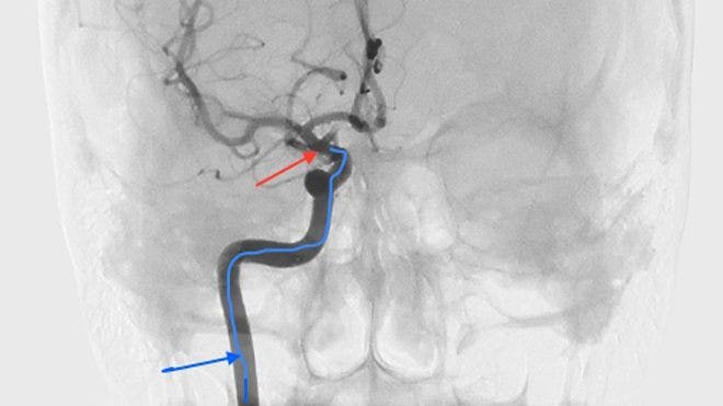 Sel induk dapat dengan aman dimasukkan ke dalam otak untuk mempercepat pemulihan stroke, demikian temuan penelitian