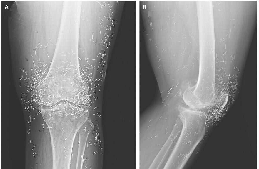 Xray reveals hundreds of gold acupuncture needles left in woman's