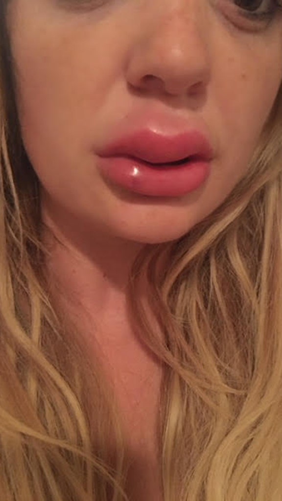 swollen-upper-lip-after-filler-sitelip