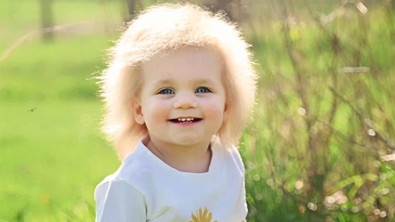 What causes uncombable hair syndrome? | Fox News