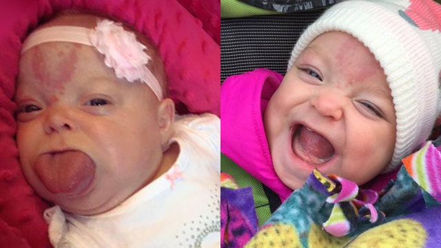 Baby born with enlarged tongue smiles for first time | Fox News