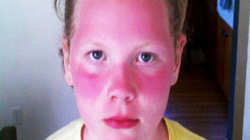 Girls Badly Sunburned When School Requires Doctors Note For Sunscreen 