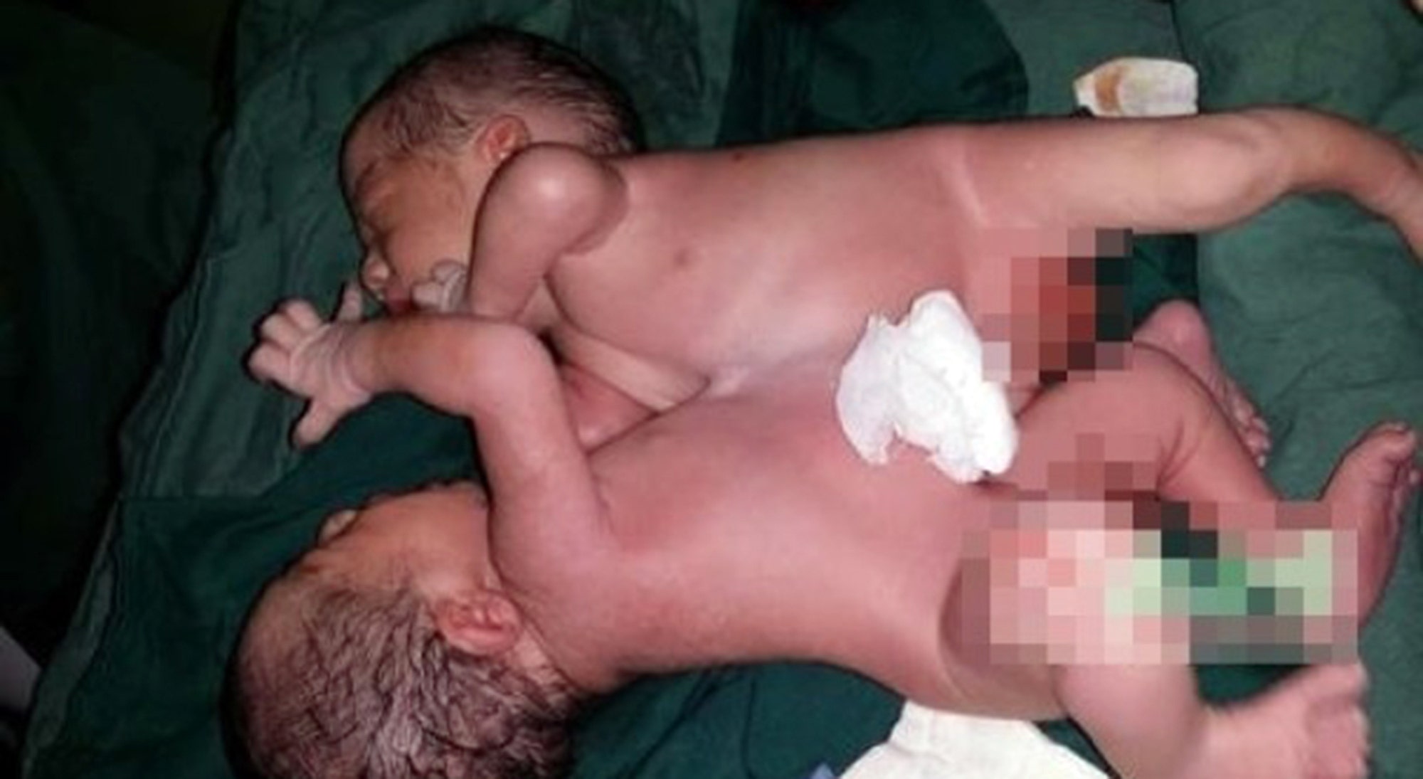 Conjoined twins are successfully separated after being locked in embrace