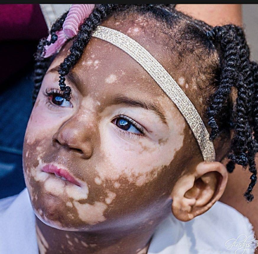 5 year old Girl Develops Blotchy Skin Disease All Over Her Body 5 year old Girl Develops Blotchy Skin Disease All Over Her Body