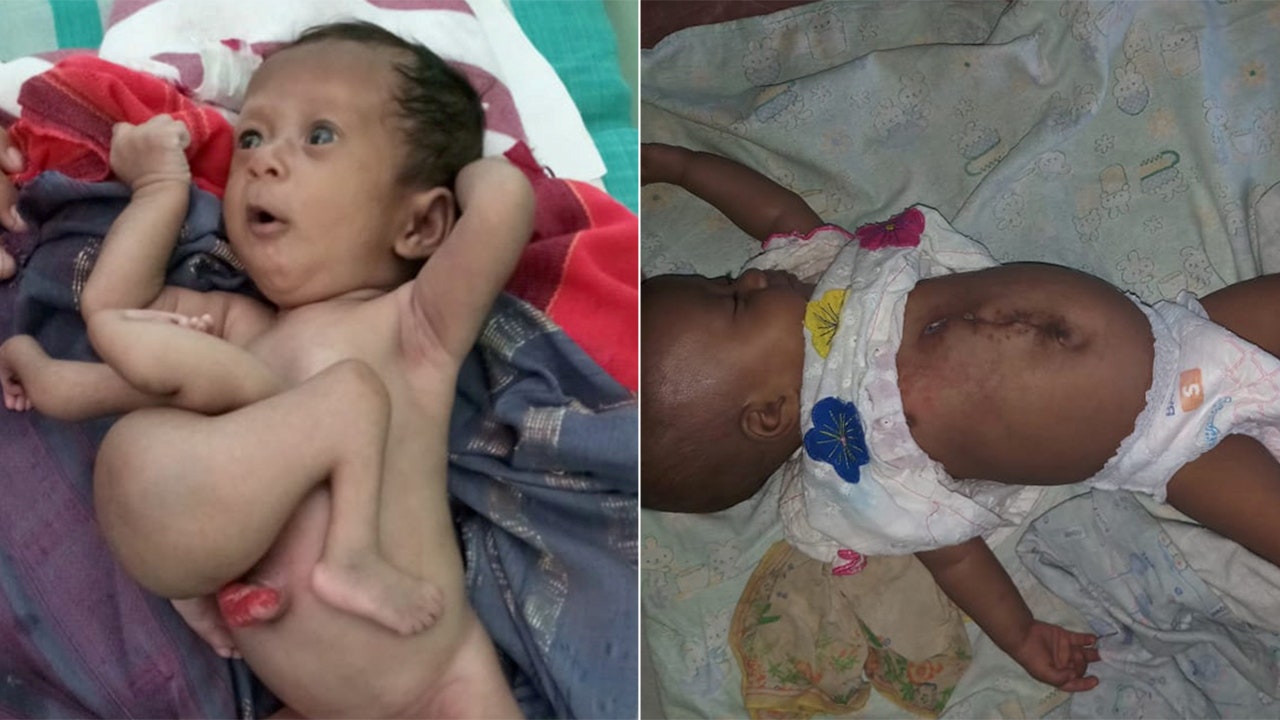 baby-born-with-parasitic-twin-has-extra-limbs-removed-fox-news