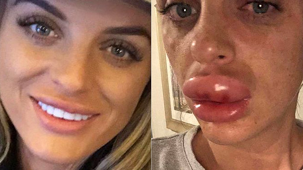 Woman Nearly Lost Top Lip After Getting Botched Fillers At Botox Party Fox News 