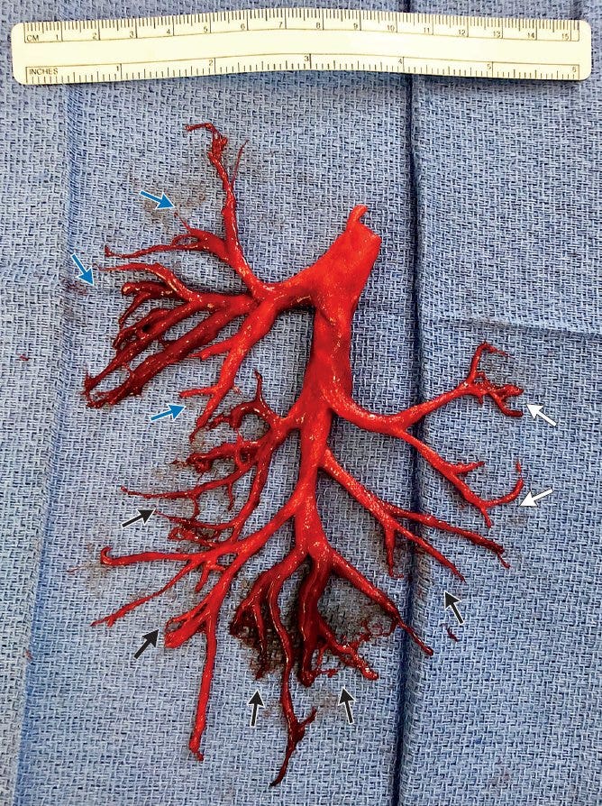 Patient coughs up blood clot in shape of lung passage: report