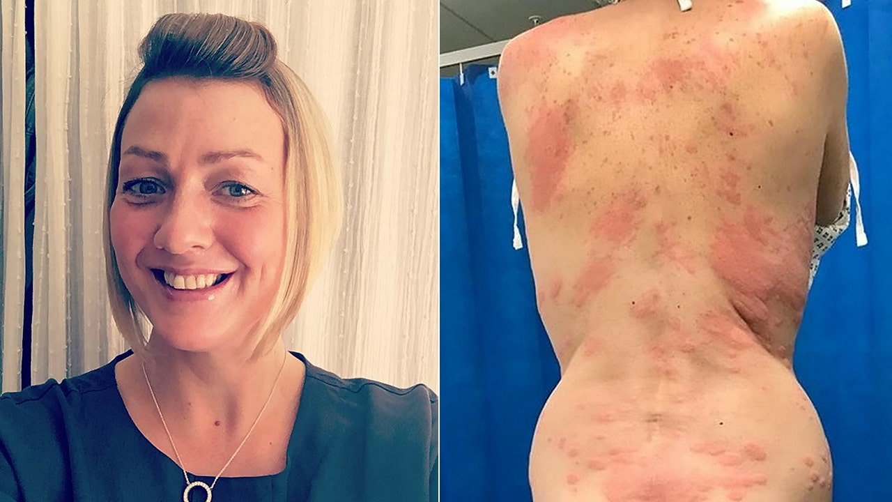 Woman claims allergic reaction to vape caused painful rash, required hospital visit