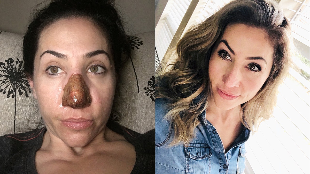 Texas Woman Has Skin Burned Off To Treat Rare Condition That Caused