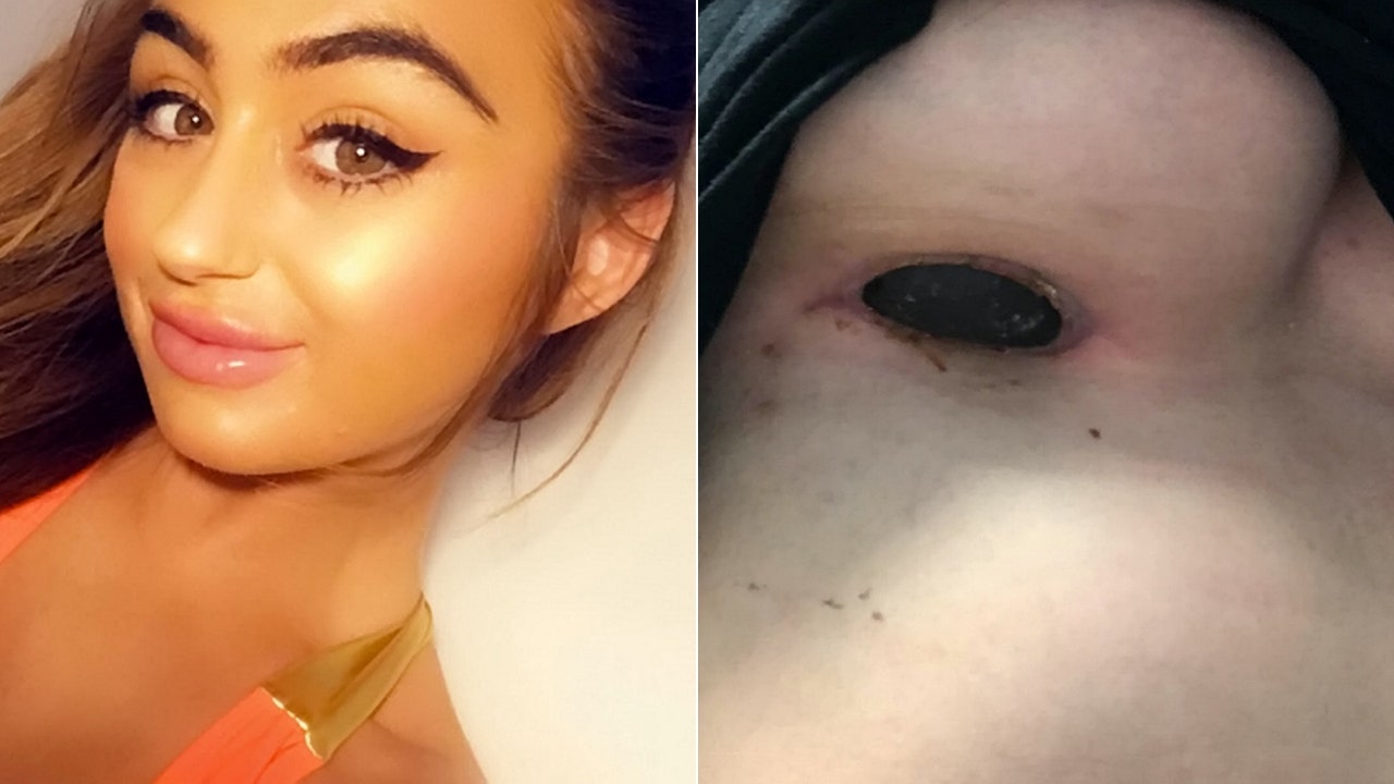 Woman claims implant scar smelled 'like rotten meat' after botche...