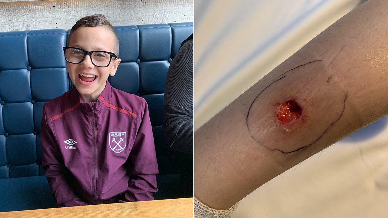 Apparent spider bite leaves boy with gruesome hole