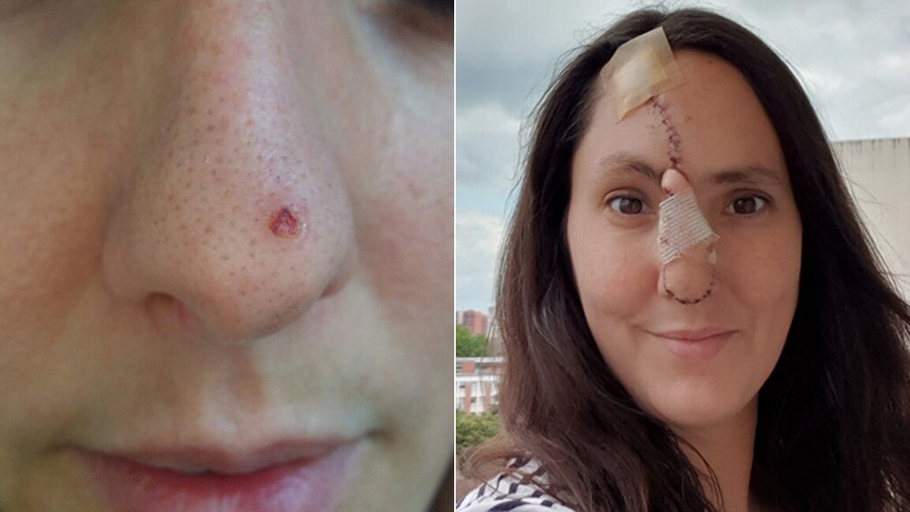 Mom loses tip of nose after dismissing skin cancer symptom as pimple | Fox  News