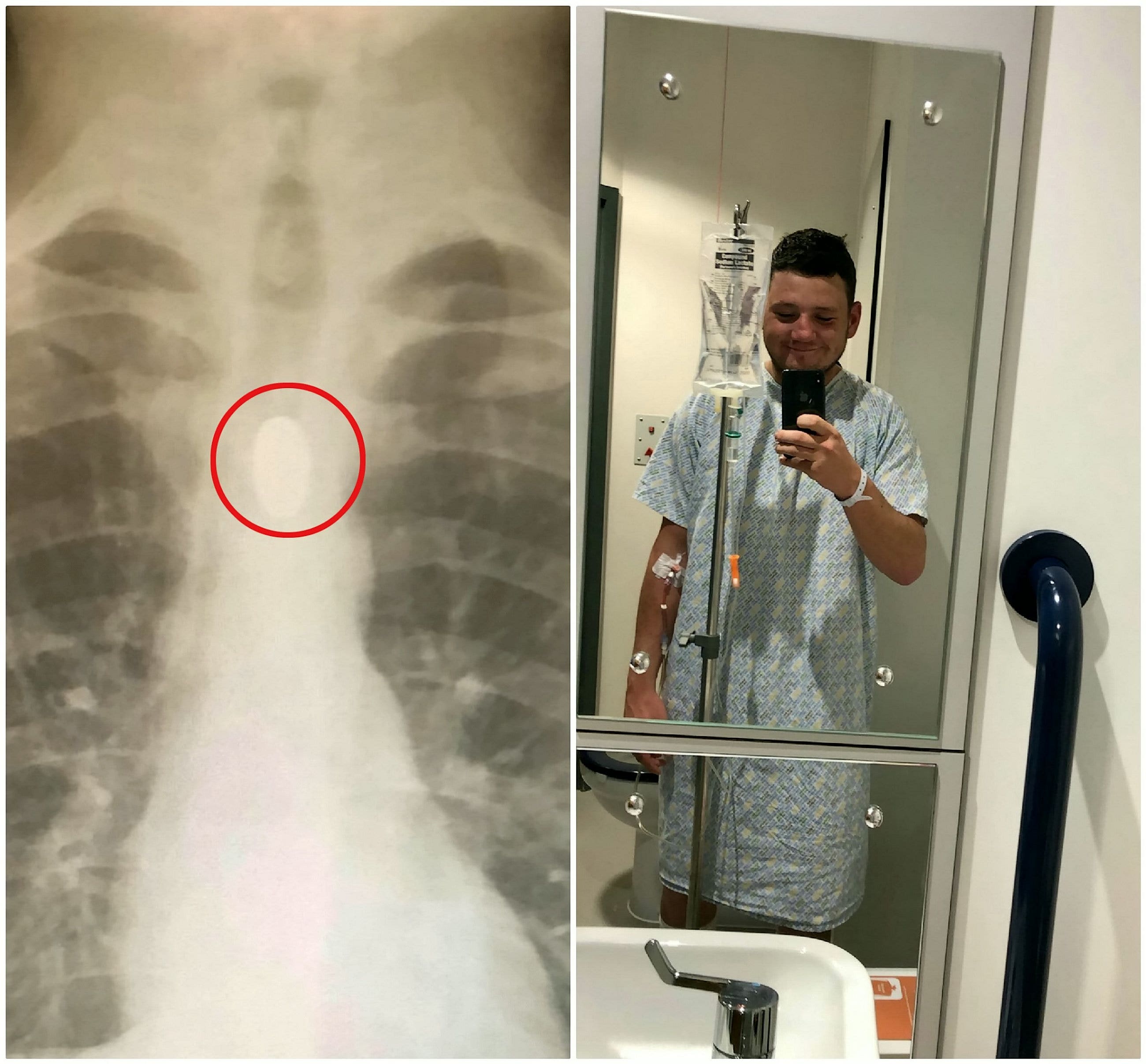 Man who landed in hospital after swallowing coin at party swears off stunt: 'Dad thinks I'm an idiot' - Fox News thumbnail