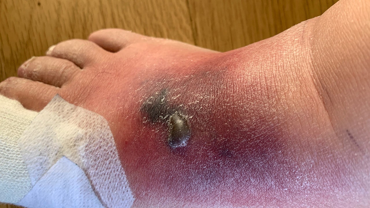 My spider bite and what I did to heal - everywomanover29 blog