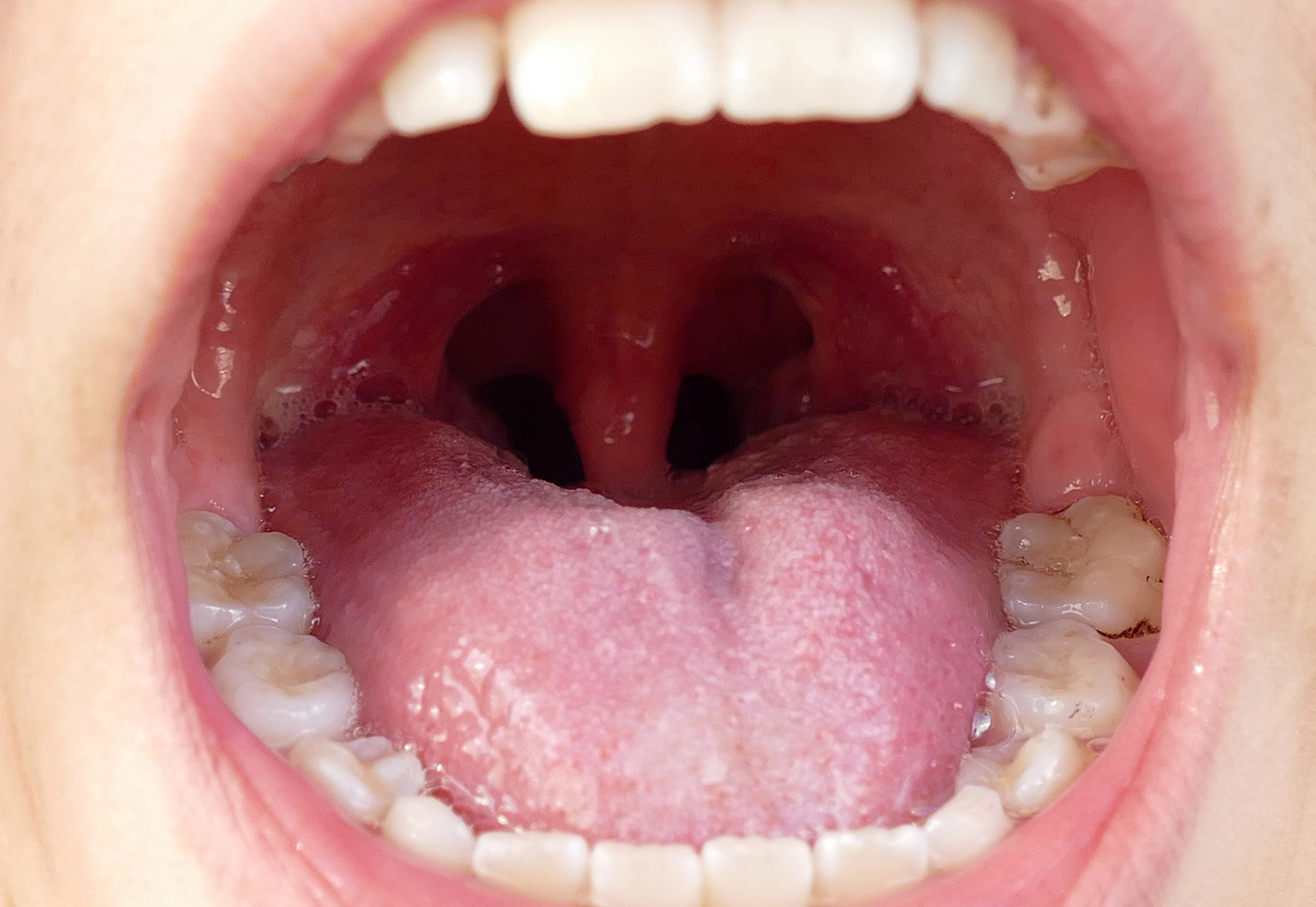 What are tonsil stones — and how do you know if you have them? | Fox News