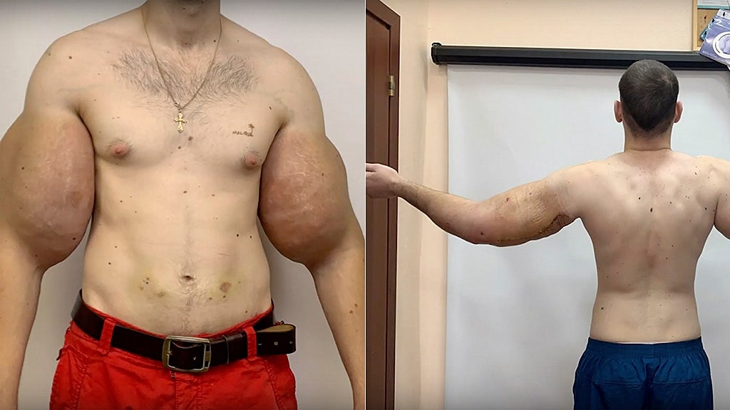 Russian Popeye' explains injecting oil into biceps and admits 'it can't be fixed' - Daily Star