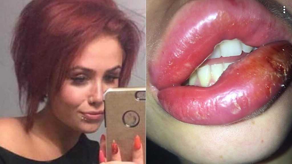 My wedding was ruined because botched filler gave me 'hot dog' lips