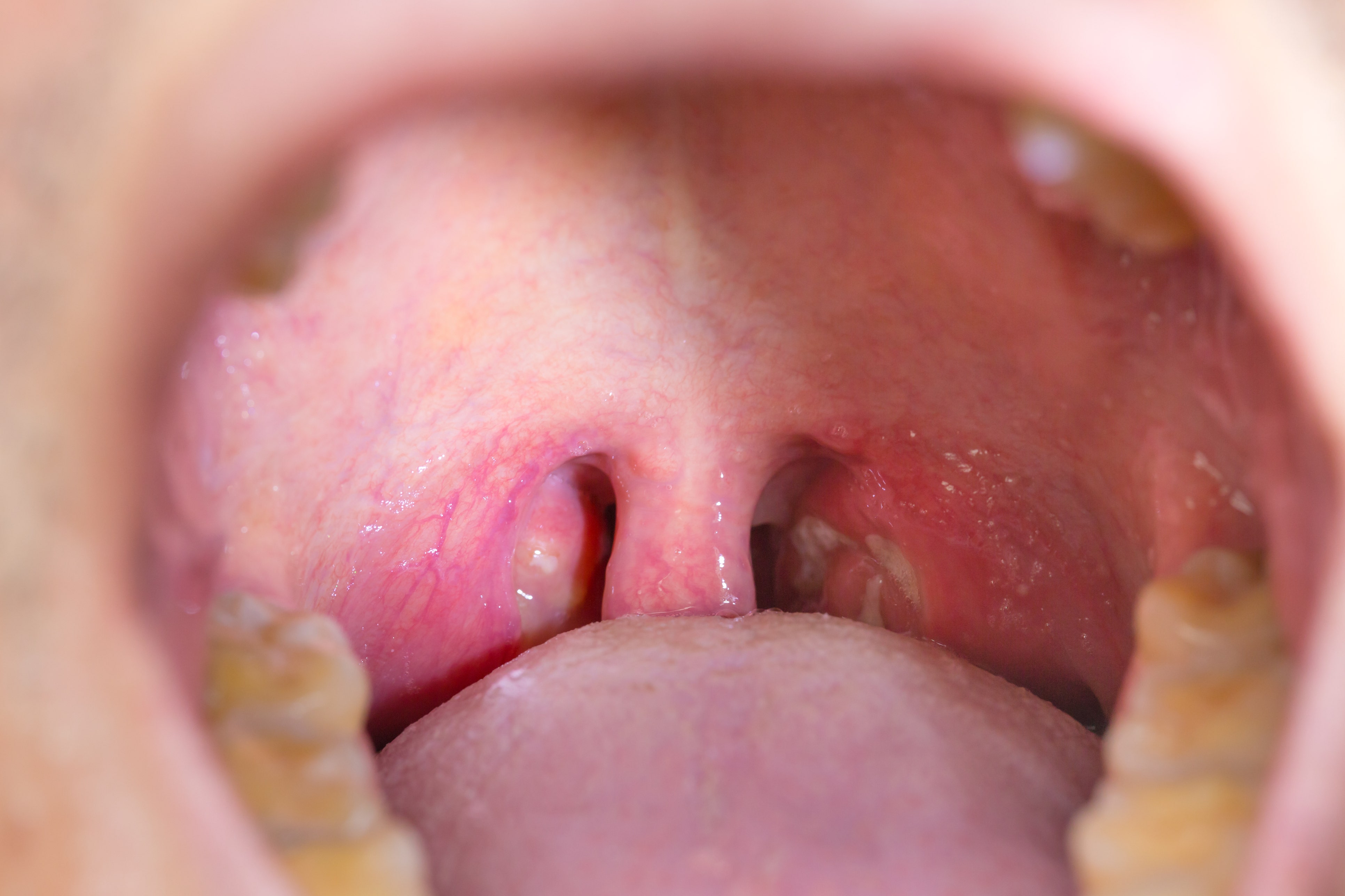 tonsils removed pictures