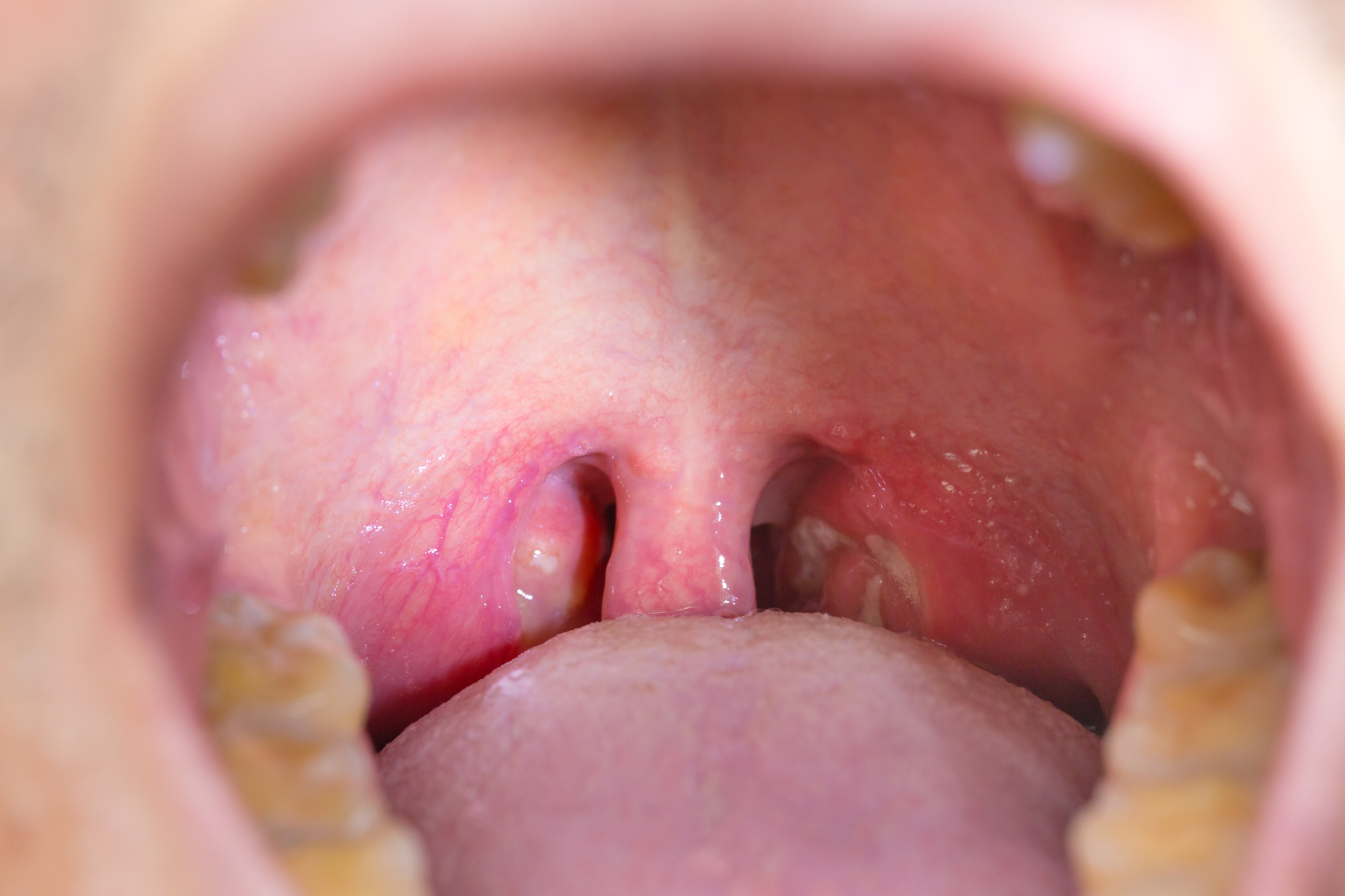 Can You Get Your Tonsils Out As An Adult