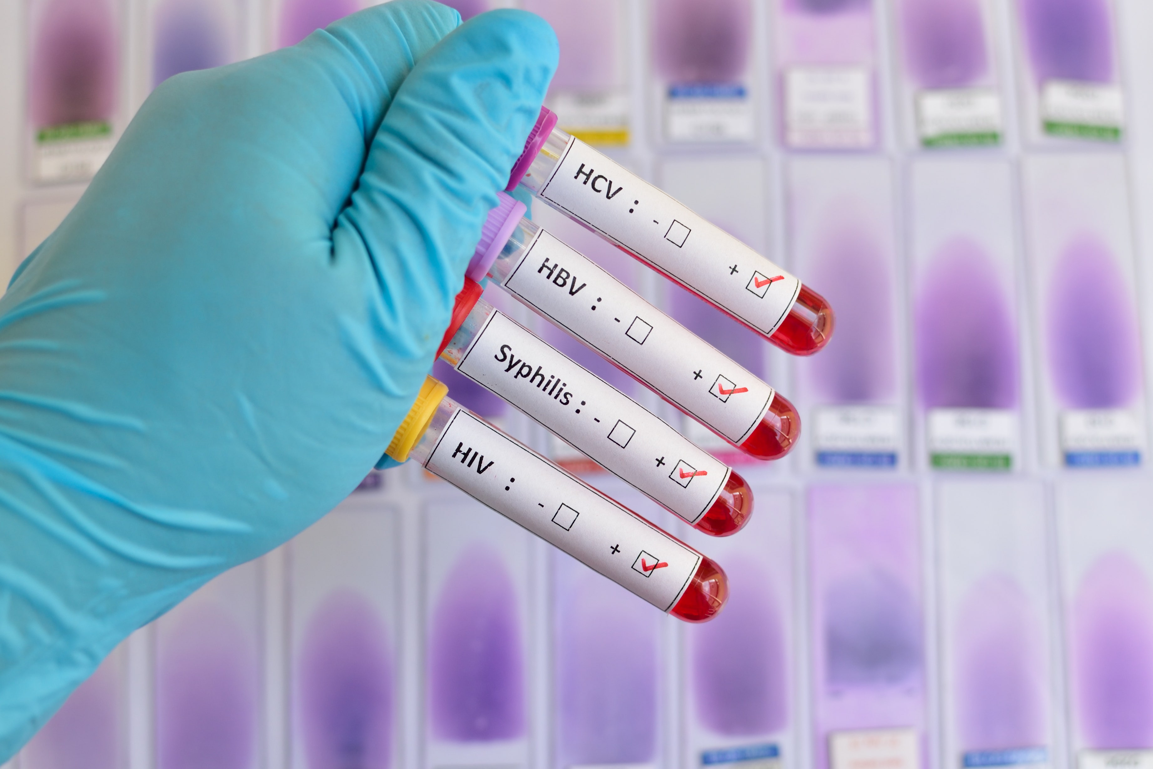 Лечение заболеваний передающихся. Пробирки для забора крови на ВИЧ И гепатит. Пробирка цвет для гепатита в ,с,ВИЧ,сифилис. Цвет пробирки для забора крови на СПИД. Кровь на гепатит в в пробирках.