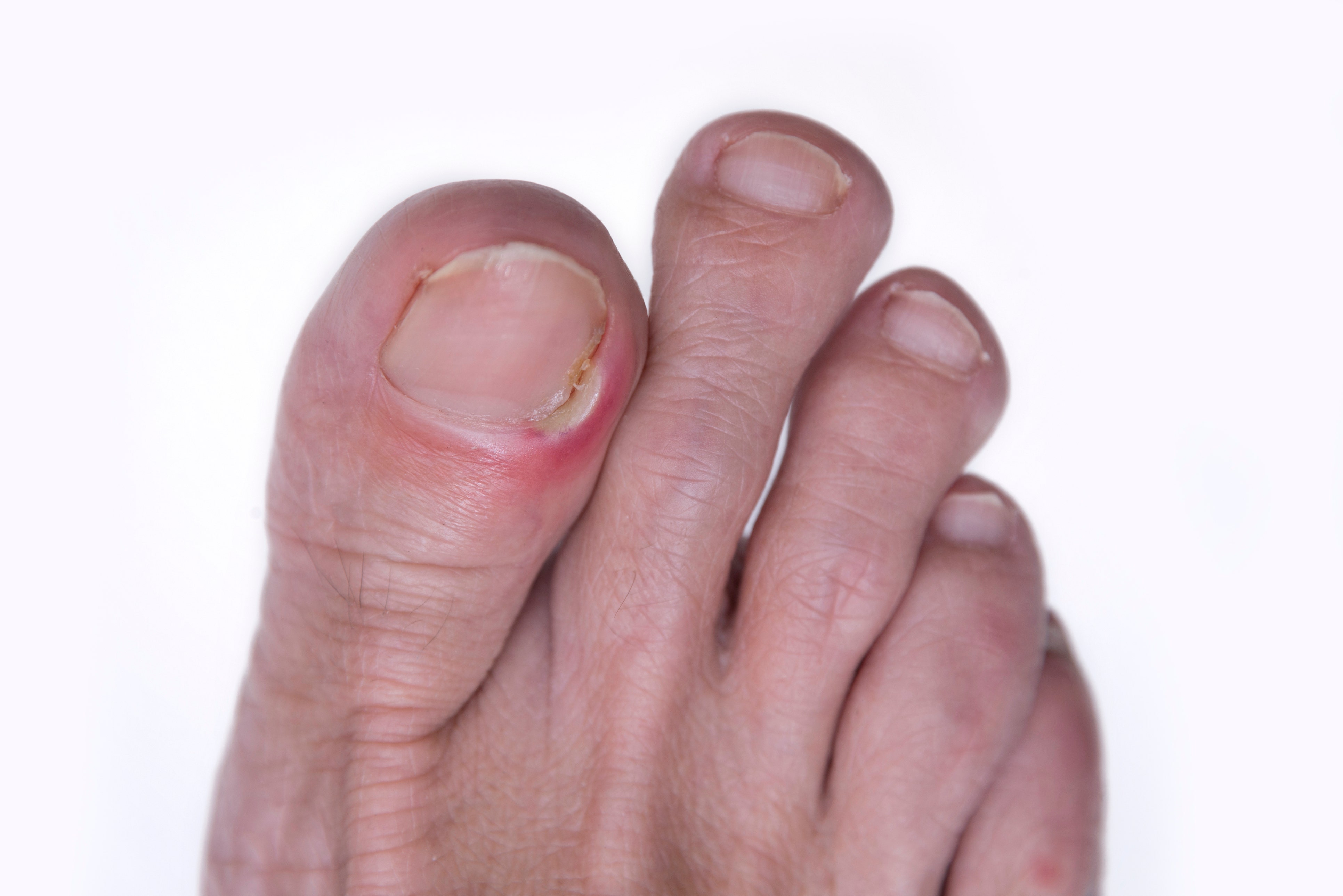 Feet on the floor. Damaged nails. Bruise under thumb nail. Barefoot close  up. Nail illness. Health treatment. Foot care concept. Foot infection Stock  Photo - Alamy