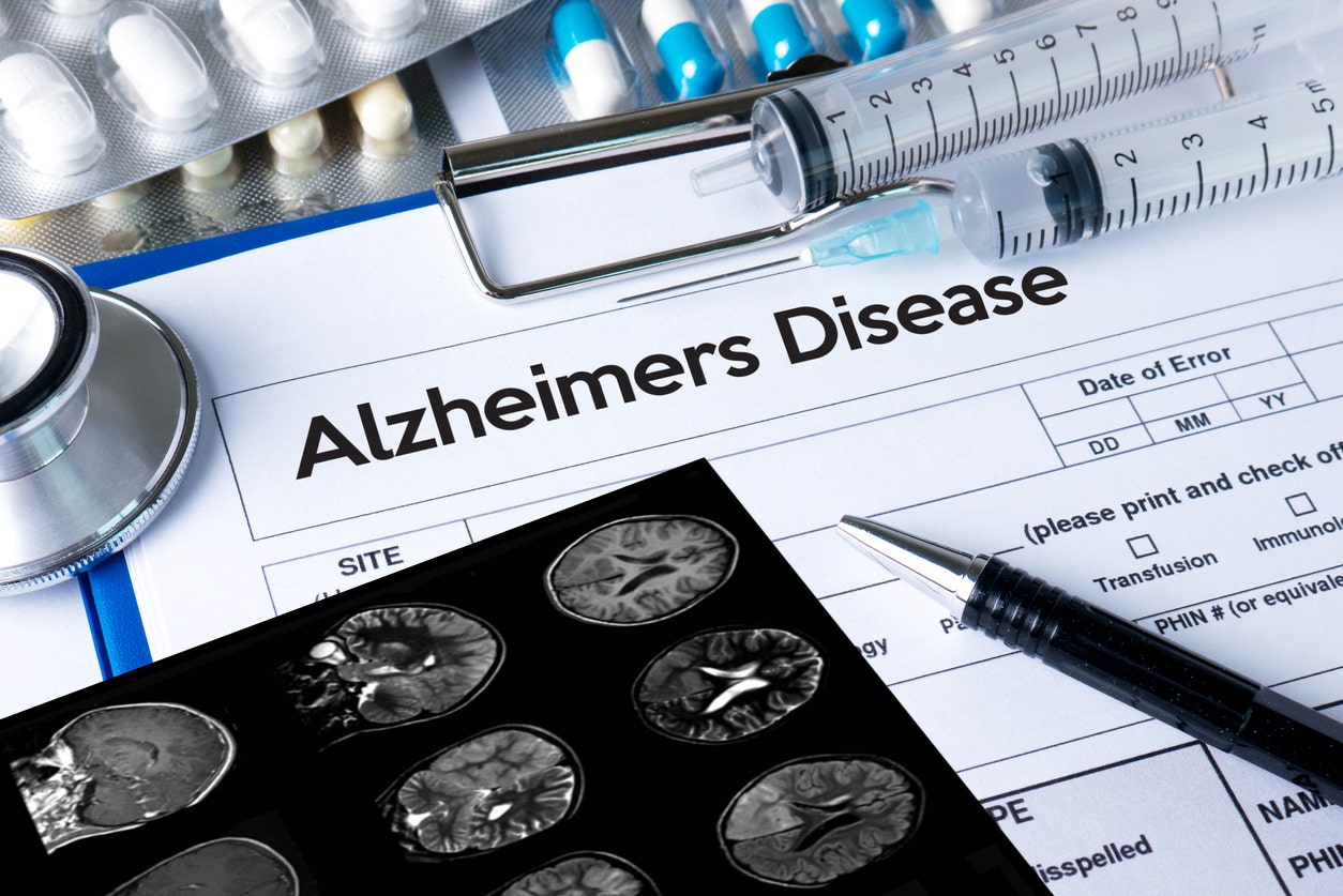 Alzheimer's disease may be detectable by key blood test, study finds
