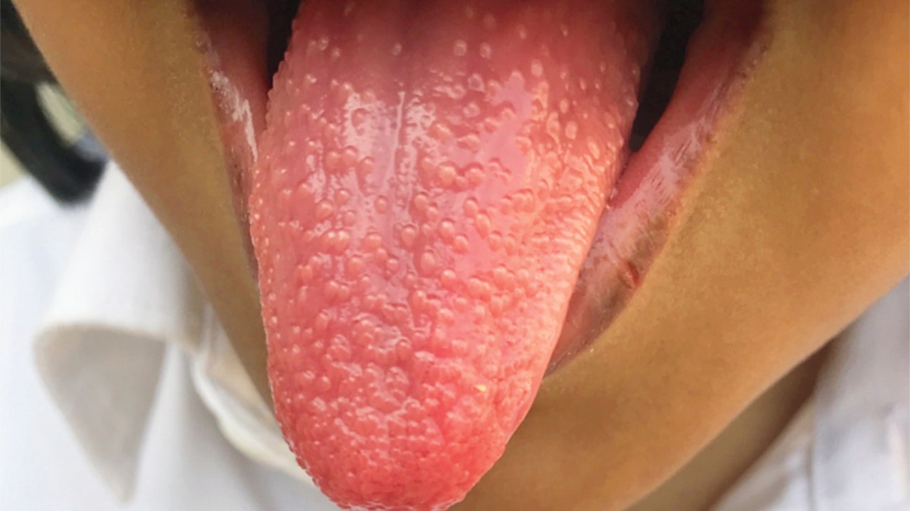 Girl develops 'strawberry tongue' during bout with strep throat