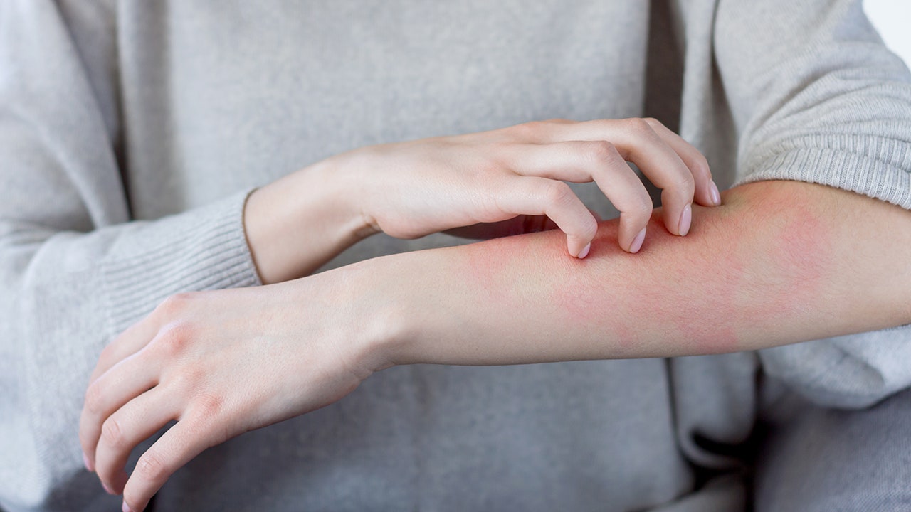 Some doctors say that Modern COVID-19 vaccines experience delayed skin reactions