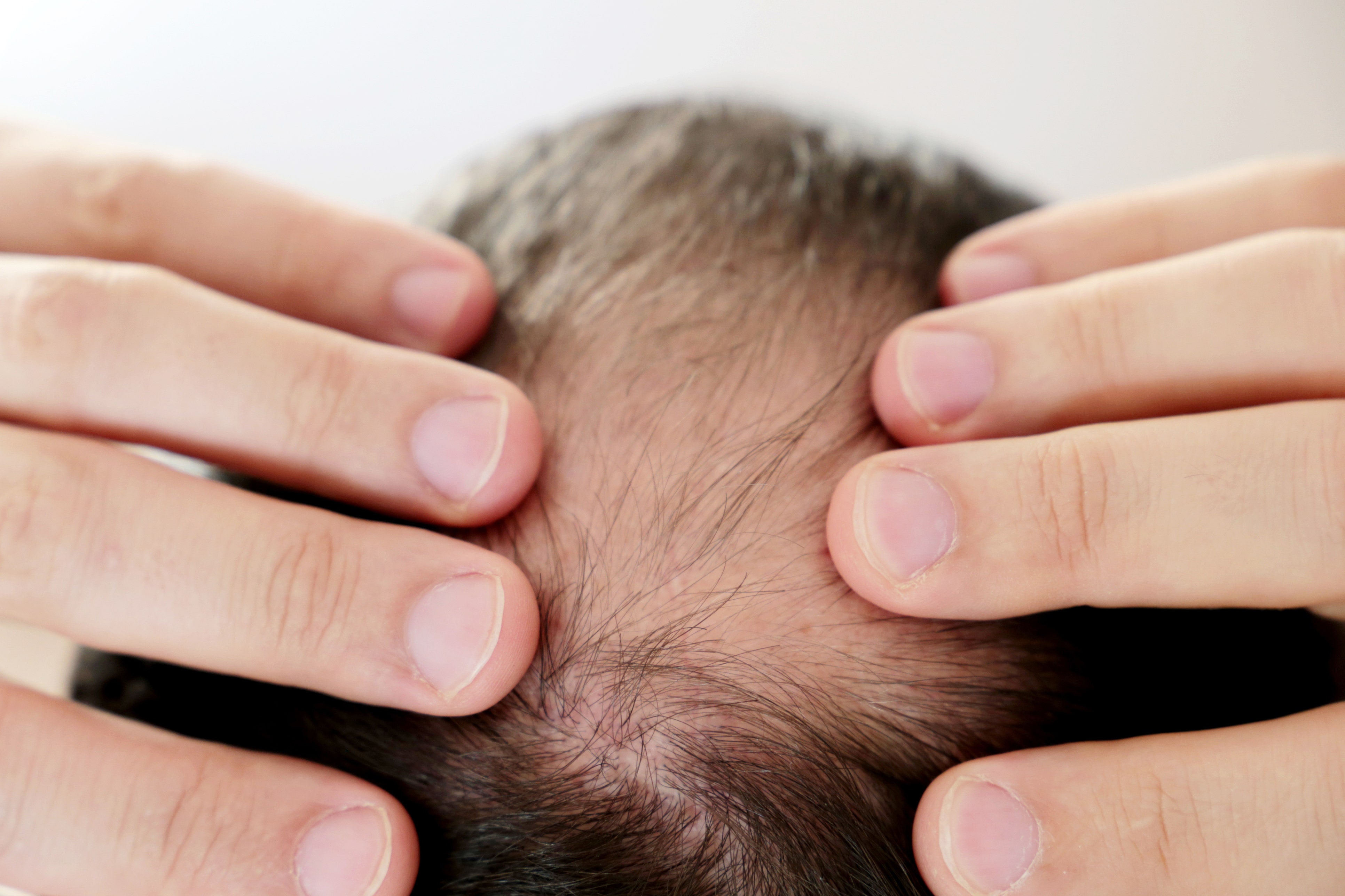 Why can chronic stress result in hair loss? New research provides clues