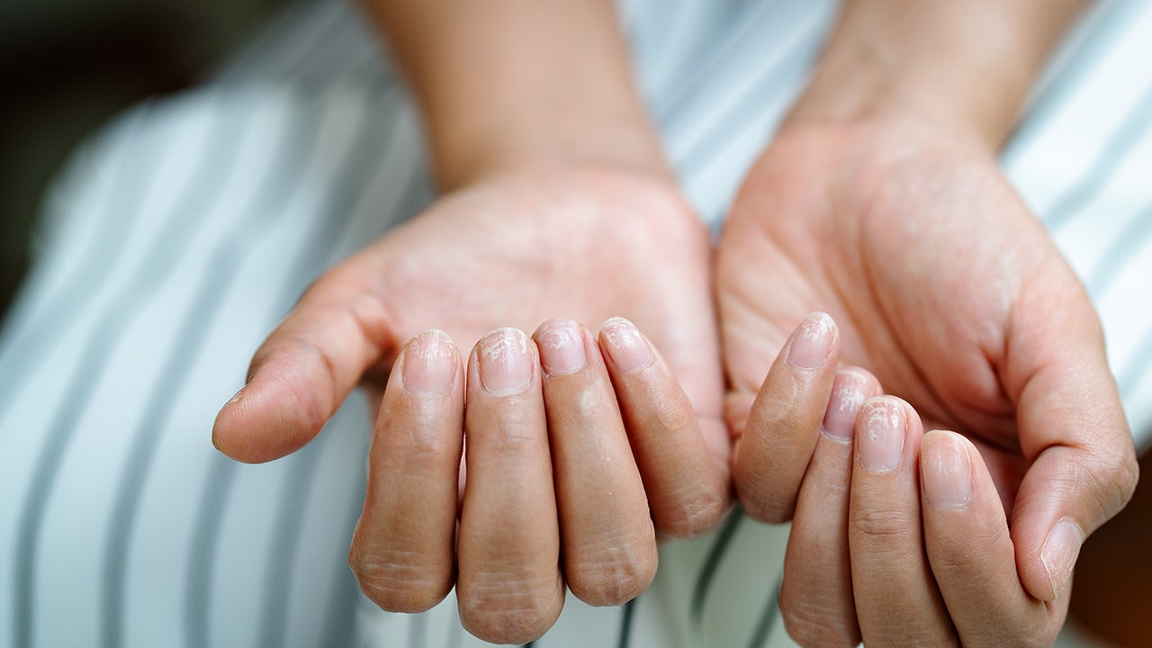 What are so-called COVID nails?