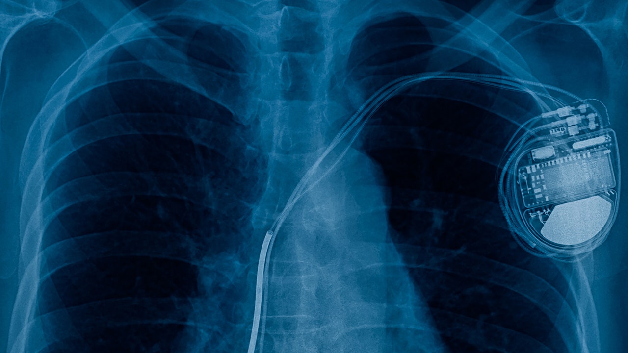 Pacemakers recalled over risk of electrical short
