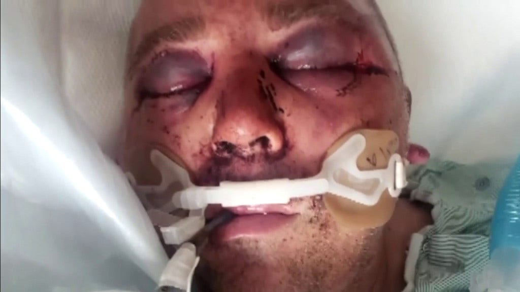 Florida man brutally beaten, put in a coma after asking neighbors to lower music