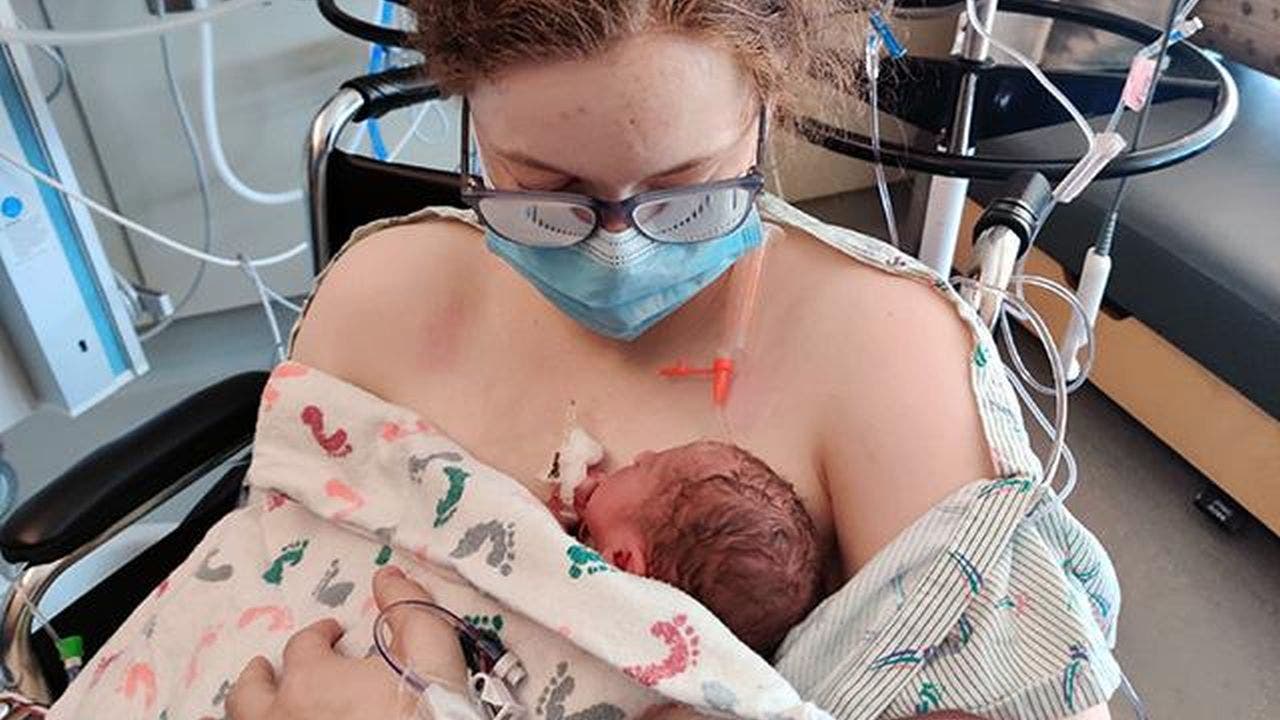 Formerly conjoined twin gives birth at hospital where she was born